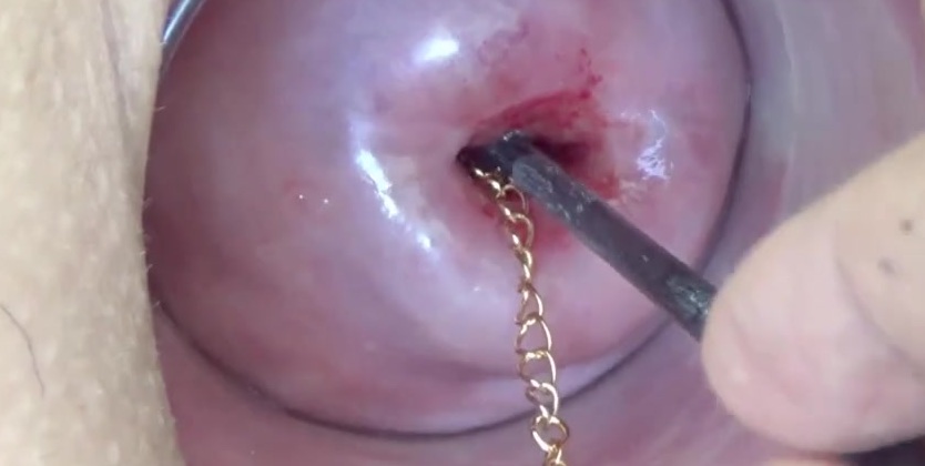 Its Porn Extreme Cervix Playing With Insertion Metal Chain In Uterus